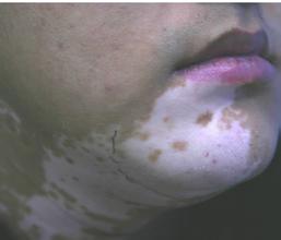 白癜风复发需要注意什么 白癜风复发需要注意什么.jpg