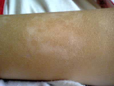 白斑患者如何缓解压力 白斑患者如何缓解压力.jpg