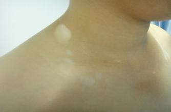 引发白癜风产生的原因有哪些 引发白癜风产生的原因有哪些.jpg