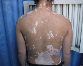 小孩治疗白癜风需要注意什么 小孩治疗白癜风需要注意什么.jpg