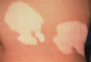 怎样正确治疗白癜风呢 怎样正确治疗白癜风呢.jpg