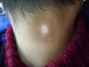 颈部的白癜风要注意这样治疗.jpg