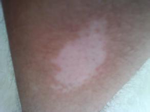 激光治疗白癜风多久能看到效果 激光治疗白癜风多久能看到效果.jpg