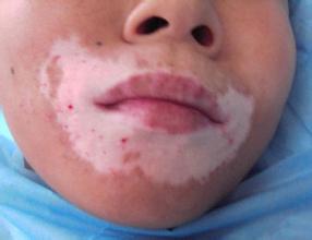 脸上长白斑的原因有哪些 脸上长白斑的原因有哪些.jpg