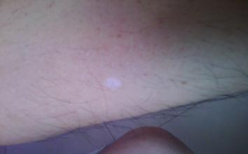 老年白癜风需要接受治疗吗 老年白癜风需要接受治疗吗.jpg