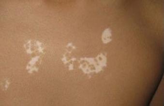 怀孕了得白癜风怎么办才能避免危害呢 怀孕了得白癜风怎么办才能避免危害呢.jpg