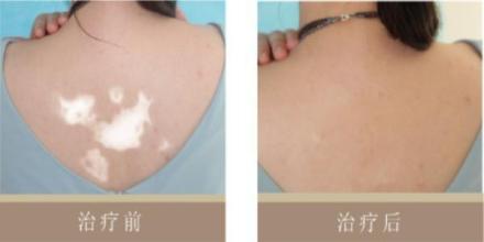 治疗白癜风哪几种方法比较适合.jpg